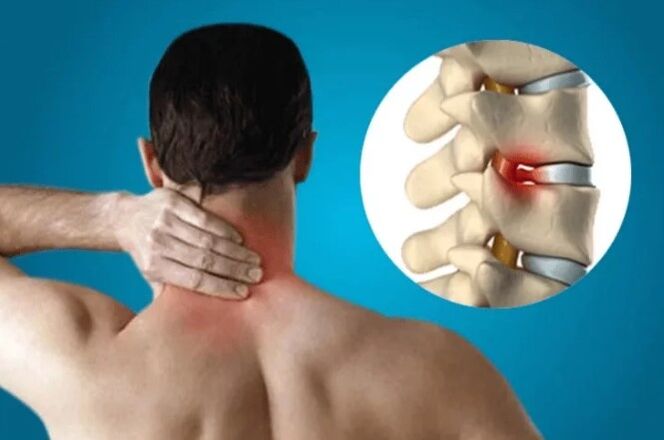 A gerinc osteochondrosis
