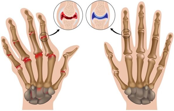 az ujjak deformációja arthrosis miatt