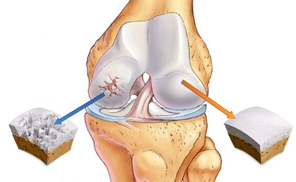 egészséges porc és arthrosis által érintett porc