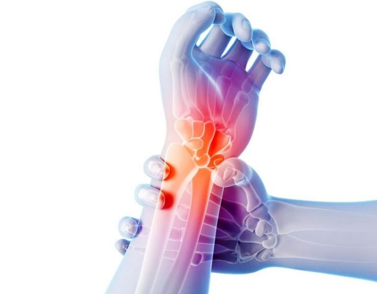 Az ízületek arthrosisát fájdalom kíséri, és komplex kezelést igényel