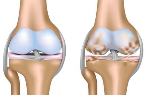 egészséges ízület és a térdízület arthrosis miatti pusztulása