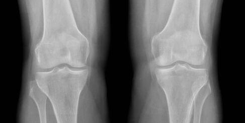 térd arthrosis röntgenfelvételen