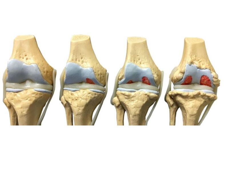 az ízületek arthrosisának mértéke